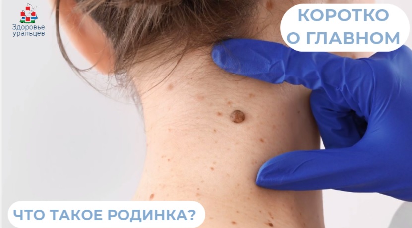 Что такое родинки?