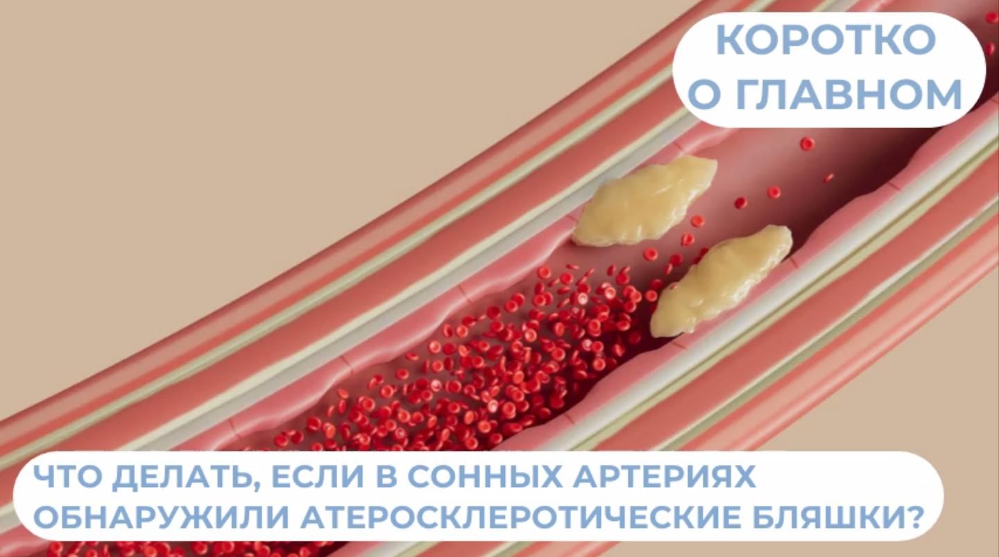 Что делать, если в сонных артериях обнаружили атеросклеротические бляшки?
