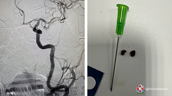 Хирурги Каменска-Уральского спасли 74-летнего пациента от последствий инсульта, внедрив новую методику удаления тромбов