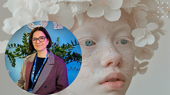 «Белые» люди: в чём причина альбинизма и как врачи помогают пациентам с этим редким заболеванием