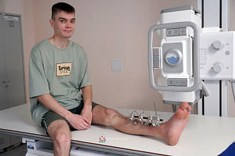  Серовские травматологи спасли раздробленную голень пациента при помощи внеочагового остеосинтеза аппаратом Хоффмана