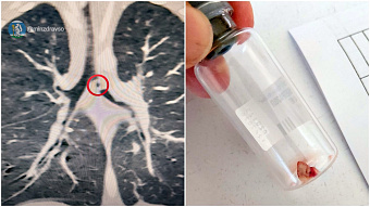 Свердловские врачи спасли годовалого малыша, у которого в бронх попал кусочек глины